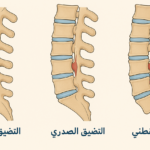 أنواع تضيق القناة الشوكية