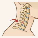 رسم توضيحي لكسور العمود الفقري الرقبي مع سهم يشير إلى موقع الكسر في فقرات الرقبة.